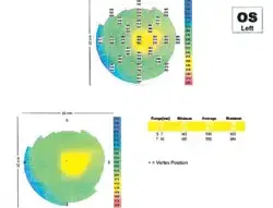 Center thickness as shown on the OCT taken 2007 after lens removal.